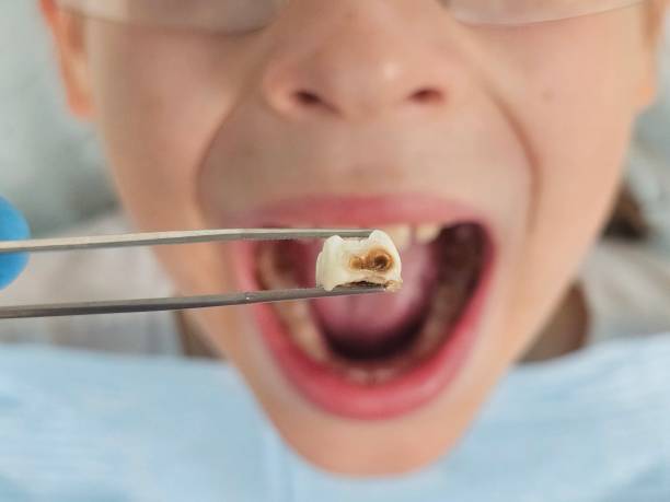 Best Knocked-Out Tooth Emergency  in Livingston, CA